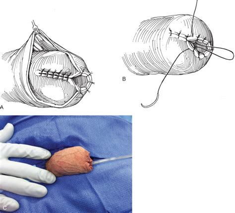 diy penectomy|Modified “parachute technique” of partial penectomy: A penile preserva.